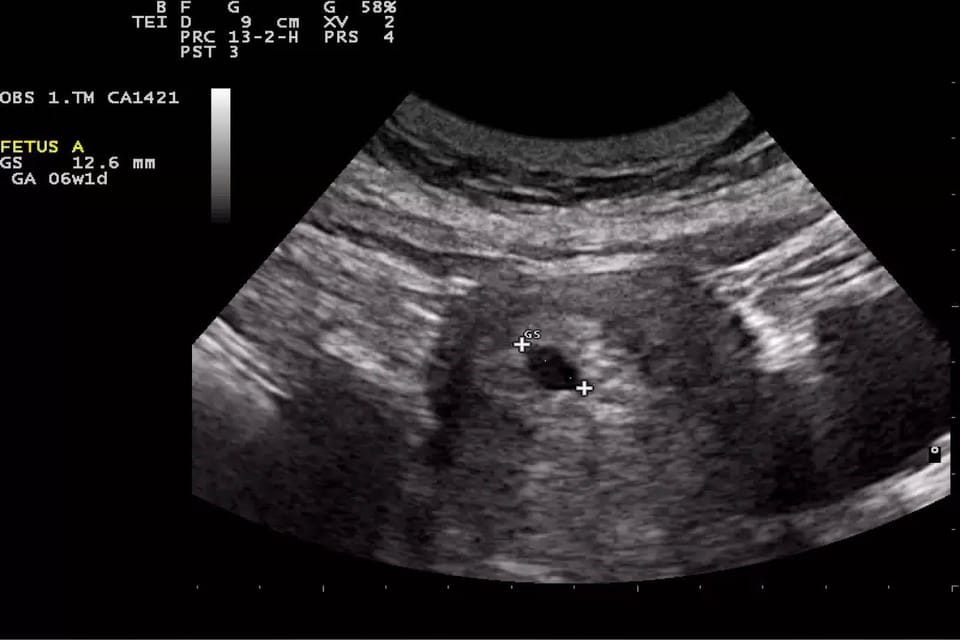 Ultrasonografía en el Primer Trimestre: Perspectivas y avances por S. Jacques Abramowicz